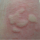 Urticaria: 9 Cara Berkesan Petua Hilangkan Gegata Pada Badan